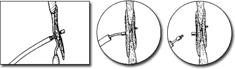 PFO Implanted